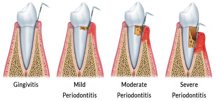 Mild Periodontitis